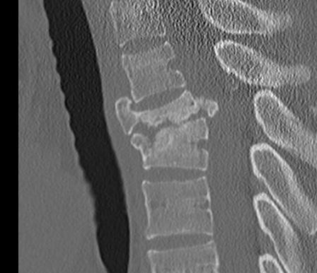 Sagittal CT